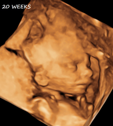 3D Second Third Trimester Obsterical Ultrasound - 20 Weeks