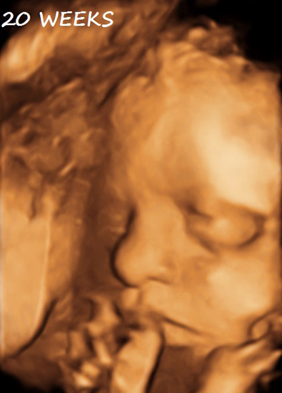 3D Second Third Trimester Obsterical Ultrasound - 20 Weeks