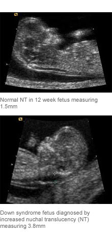 First and Second Trimester Down Syndrome Screening