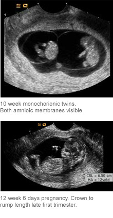 First Trimester Obsterical Ultrasound
