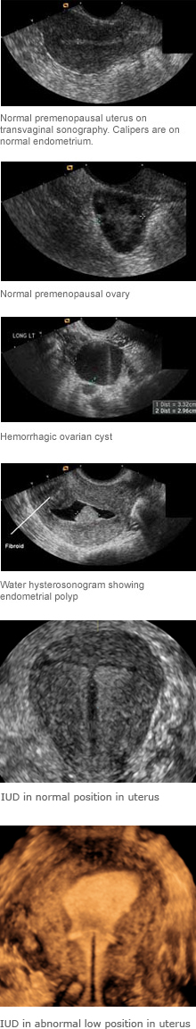 Pelvic Ultrasound and Water Hysterosonography