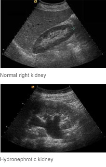 Renal / Kidney Ultrasound