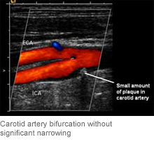 Vascular: Carotid, Renal Artery and Venous Ultrasound
